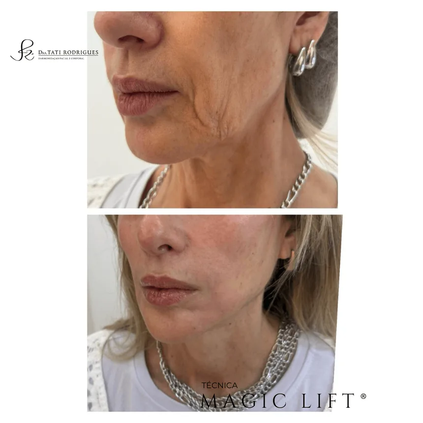 Comparação antes e depois em vista de perfil, com a técnica Magic Lift