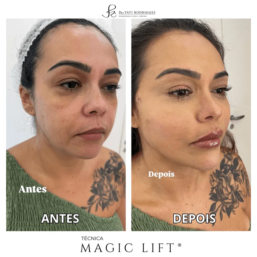 Comparação antes e depois de um caso com a técnica Magic Lift