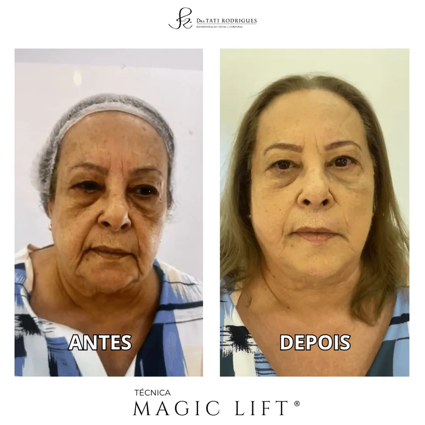 Comparação antes e depois lado a lado, em vista frontal