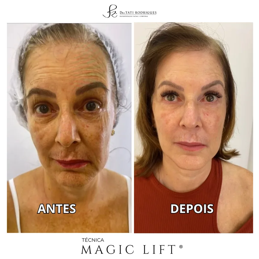 Outra comparação antes e depois em vista frontal