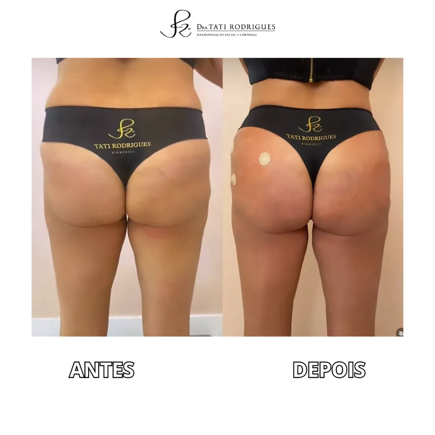 Comparação antes e depois de harmonização glútea, em vista posterior