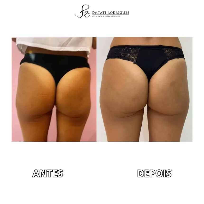 Outra comparação antes e depois de harmonização glútea, lado a lado